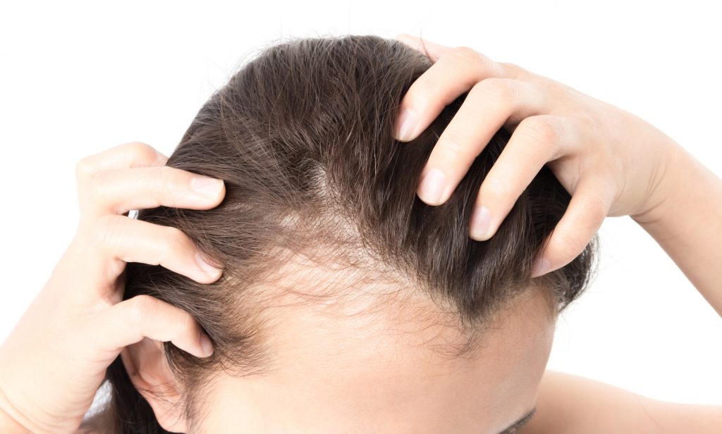 natural hair loss treatment