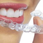 Invisalign What Is It And Why Should You Have It