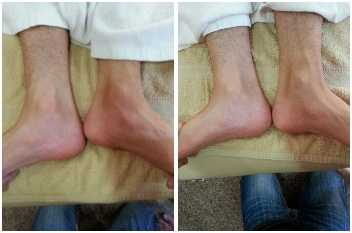 short leg syndrome