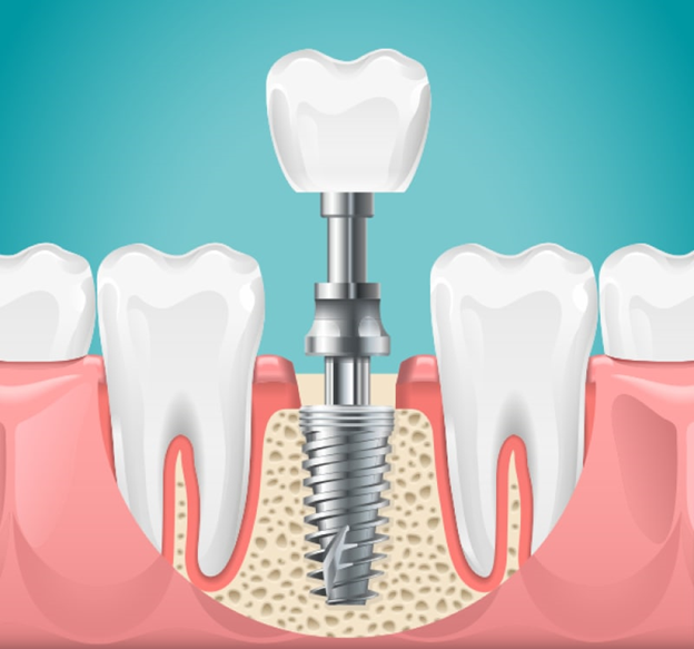 The Successful Placement of Implant Post